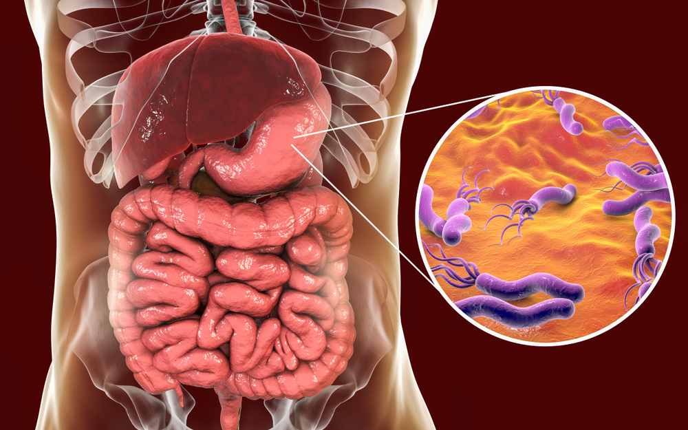Helicobacter pylori, bacteria care poate declansa cancerul de stomac