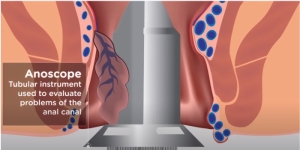 tratament hemoroizi laser