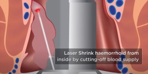 tratament hemoroizi laser