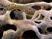 Ca urmare a osteoporozei, oasele formeaza o structura poroasa anormala, compresibila, ca un burete