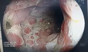 boala Crohn M 42 ani